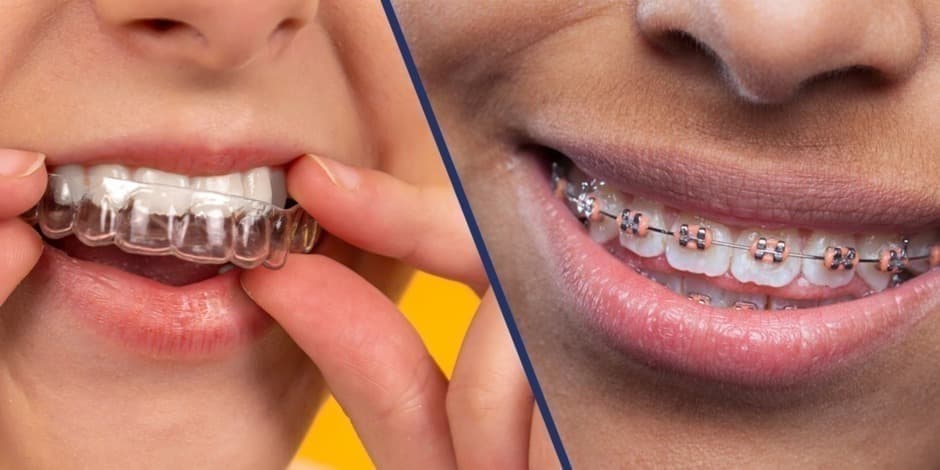 Dantų poliravimas po ortodontinio gydymo