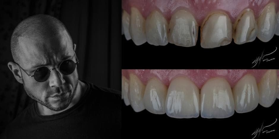 Priekinių ir šoninių dantų estetinis plombavimas: autorinis dr. Viktor Scherbakov master kursas "Zen"